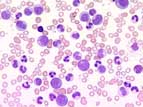 Leukemia