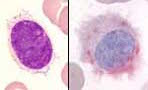 Leukemia